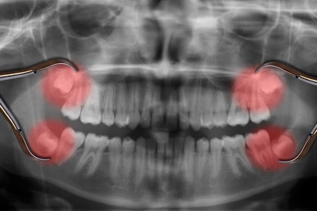 Top 10 Wisdom Teeth