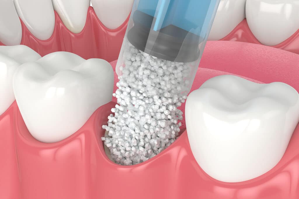 Bone Grafting After Tooth Loss: Why It’s Crucial for Future Implants