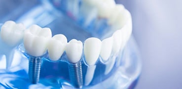 Dental Implants Image