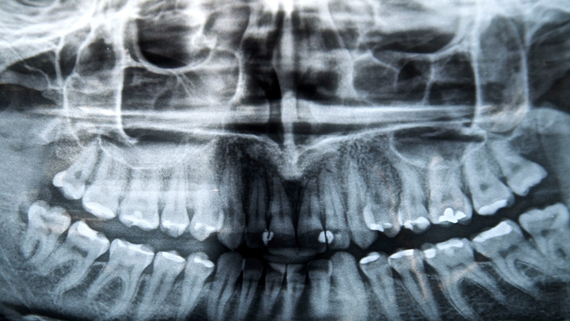 Sinus Lift image