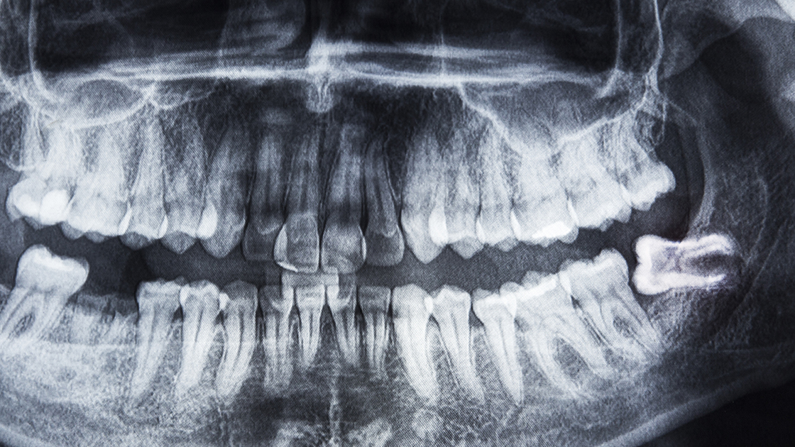 xray showing impacted wisdom teeth